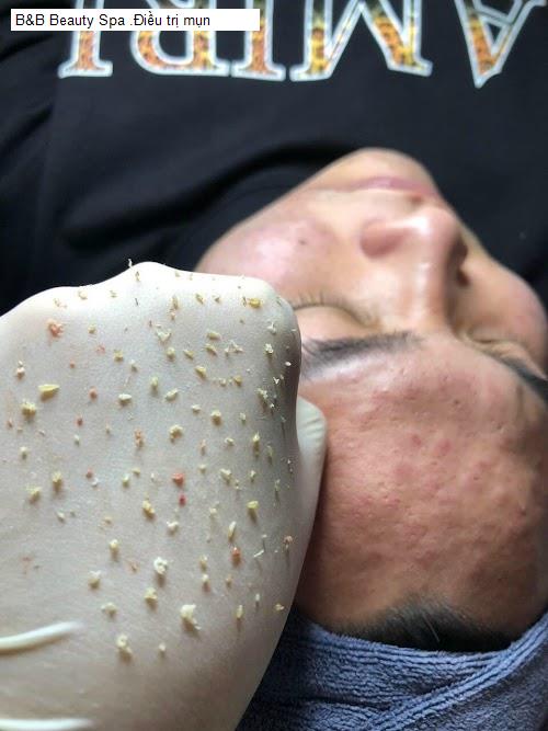 b&b beauty spa .dieu tri mun