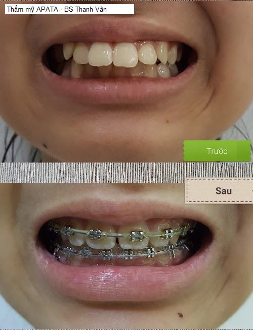 tham my apata - bs thanh van